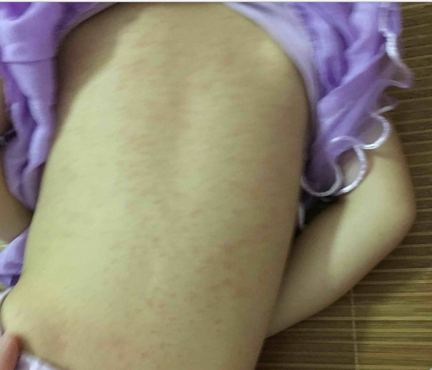 三周岁半的女宝，后背好多痱子，怎么办