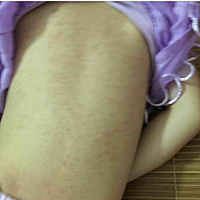 三周岁半的女宝，后背好多痱子，怎么办