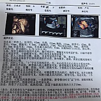 10.1号去做四维彩超！发现宝宝膀胱处有一个5❌8mm的不规则的囊样回声！你们有没有遇到过！宝妈们！这严...