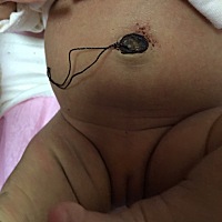 8天的新生儿消毒肚脐的时候擦出一点血丝，后来发现护脐带有干了的血迹