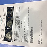 今天去做彩超，怀孕30周 3，检查说胎儿绕颈一周，那后期宝宝会自己把脐带弄出来吗？好担心到时候不可以...