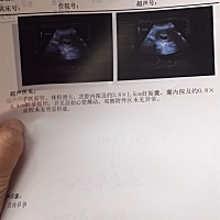 孕50天男孩女孩啊？都说形状可以分辨 是真的吗？