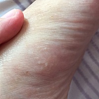 怀孕四个月了，手脚一挠就有小水泡，奇痒无比，特别是半夜里痒到睡不着