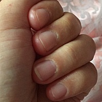 怀孕四个月指甲全部跟肉分离，是什么情况？