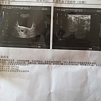 50天了，今天做b超没有胎心胎芽，有没有和我一样的，后来都我有的，医生让一周后复查，好担心啊