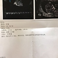 有宝妈会NT单子看男女吗，明年5月预产期