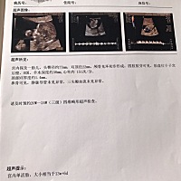 哪位懂的帮我看看是男孩女孩、前两天刚做完NT 、做的时候拍的好清晰啊、可惜我不会看性别、清楚的照片医...