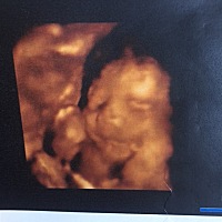 医生说我太胖看不太清楚 我仔细看了一下 比好多四维都看得清楚 医生这是想告诉我是男孩还是女孩吗👧