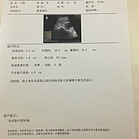 孕16周，做唐氏筛查说有点小，第一次检查也说小，结果得等2个 星期后出，我以为他有了胎动，第二次为什...