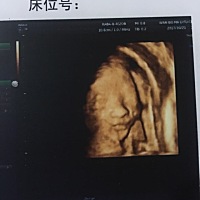 有预产期18年2月份的准妈妈吗？上周刚做完四维，进来聊聊啊。