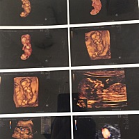 13周➕6做的煊光四维超生筛查 医生说宝宝很健康 又一次心里的大石头放下来 嘿嘿