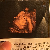 四维顺利通过整个过程也就几分钟，每天在肚子里超级好动的😅想要个男宝宝…😜