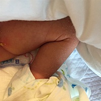 宝宝屁股旁边长脓包了怎么办。