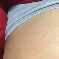 现在18周了，有怀孕妈妈肚皮两边会出现红红的一块块的吗？这是什么情况？