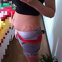 宝妈们，你们有妊辰纹吗？我已经产后两个月了，虽然瘦下来了，但是妊辰纹还有，该怎么消除啊，看看我顺...