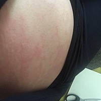 肚子好红好痒呀。有没有同样情况的宝妈。现在18周了，怎么回事呀，也没吃错什么呀