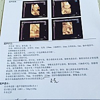 今天做四维彩超，单子上说羊水多，有宝妈知道怎么办吗？好担心呢！