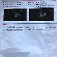 医生说孕囊张力欠佳，但是我看Hcg和孕酮值都挺正常，偶有流咖啡色物，担心啊，我这个孕囊形状是不是不干...