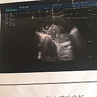 宝妈们，看看我的宝贝是单卵双胞胎、还是龙凤双胞胎？