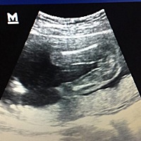 大家看看是男宝还是女宝，我看着三条线挺明显的，熟人又说太小不确定。