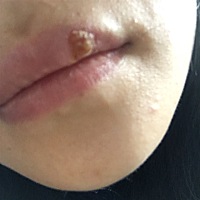 前几天嘴巴上火起了一个泡，今天已经结痂，月经第二天，这个月可以备孕吗？急，看到的姐妹回复一下