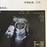 有经验的宝妈帮忙看看男女，好几次都想做掉了，这个孩子留下来好不容易