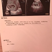 怀孕65天做的b超，哪位宝妈能看出男女么？
