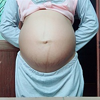 之前对那几条纹很耿耿于怀，现在觉得也没什么了，宝宝的健康，才是我真正关注的😄这些纹就是你妈妈含...