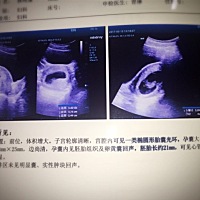 最后一次探讨男女，😌附一张第一次b超，跟刚刚拍的肚子照……等我生了，我再告诉你们哈😄倒计时咯🐣