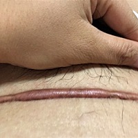 刨腹一年以后，这样正常吗？怎么能更好恢复？多久可以要孩子