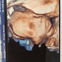 今天刚做完四维但是宝宝脐绕颈两周，各位姐妹怎么办啊