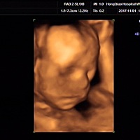 孕24周坐着吃个饭就起不来走不了路，腿根疼的不行，刚刚感觉好点没几天，现在28周屁股疼的不行，睡觉起...