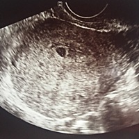 刚查出怀孕，5周到6周之间，现在还没有孕吐的感觉，只是腰疼得要命，这才刚开始啊，我滴天。。。有没有...