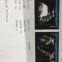 吃了避孕药还是怀孕了 25周了医生说没有事可是我总是心里慌慌的，不知道我这个小丫头还是小伙子能不能健...