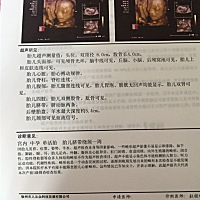 今天做的四维，医生说孩子偏小，还绕经一周，其他都挺好的
