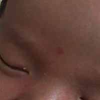 会不会真的胎记，有什么办法去除，怕怕
