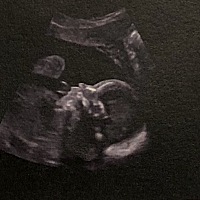 怀孕23周5天的B超，这样的宝宝算不算塌鼻子？