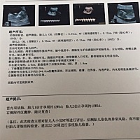 第三次NT 检查出 是双胞胎！ 在双方家没有这个基因的情况下  我激动了！翻盘了居然！接双胎好孕🤣🤣