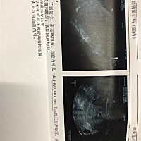 麻烦问一下：我抽血各项指标都很低，B超检查出也没明确的胚芽 只有一个暗影，而且已经出血第三天了，颜...
