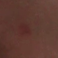 有谁知道这个是不是胎记，一按就没了，啥时候消掉