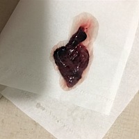 孕吐勿进。刚刚流出来的？这个是孕囊吗