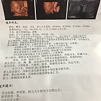 今天去照四维B超，医生说宝宝双肾有点分离，请问你们知道怎么办吗？严重吗？