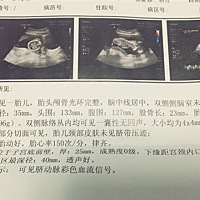 怀孕20周，想知道男孩还是女孩？麻烦有经验的宝妈帮忙看看