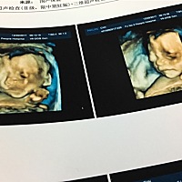 昨天做的三维，第一胎是女儿，尽管如此，这一胎不管男孩女孩都不重要，只要健健康康的就好！