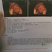 左心室内可探及一点状强回声，有没有事啊？