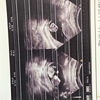 都说12周的NT能看出性别，你们看出来了吗？