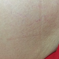 帮忙看看这个是不是妊娠纹啊？该怎么预防？