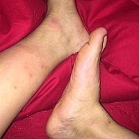 有孕妈是这种情况吗？特别痒，一抓就红，身体上也有。好痒好痒，擦护肤霜没用，其他刺激性药膏又不敢用