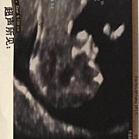 今天做了nt，医生说正常，抽血做了唐氏，要一周才出结果，超级紧张啊！之后才听说nt看孩子有鼻梁唐氏出...