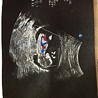 请大神帮忙看看男女宝？12周的nt结果